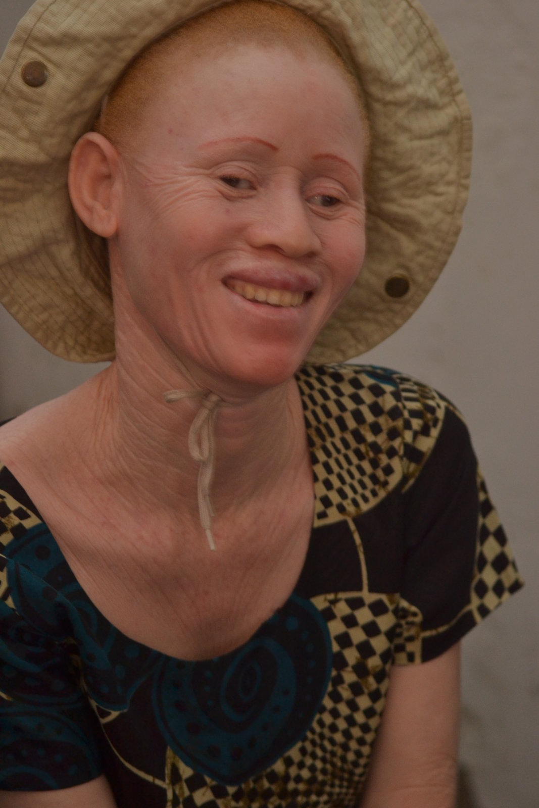 A Smile For Albinos In Tanzania